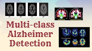 Multi class Alzheimer Detection | Deep Learning | CNN | Python | DHS