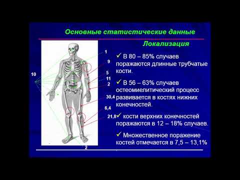 13:50 Гематогенный остеомиелит