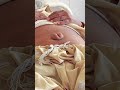 Umblical Hernia