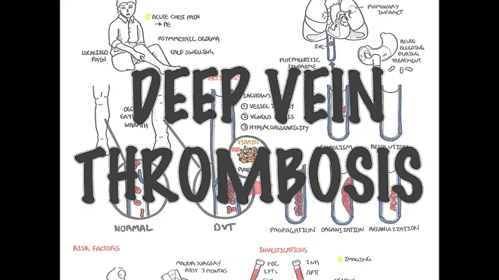 Deep Vein Thrombosis - Overview (pathophysiology, treatment, complications) - DayDayNews