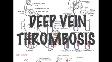 Deep Vein Thrombosis - Overview (pathophysiology, treatment, complications)