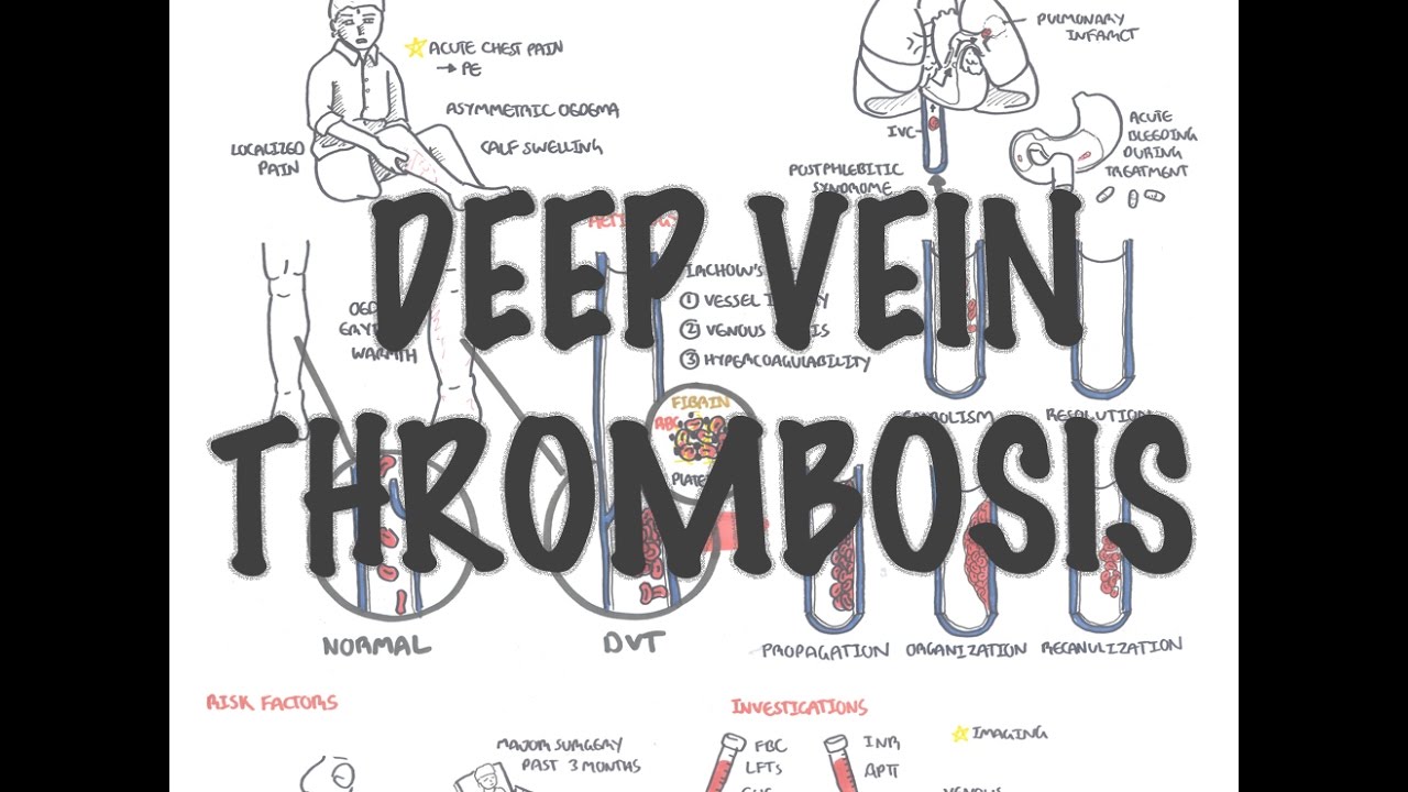 Hot Tips - Locating the Calf Vein with Ultrasound