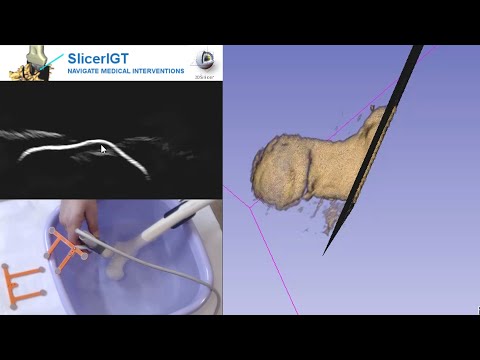 Real-time 3D ultrasound reconstruction using 3D Slicer + SlicerIGT