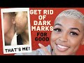 How To Get Rid Of Dark Spots + Hyperpigmentation | Black Girl Skin Care | Stubborn Dark Marks