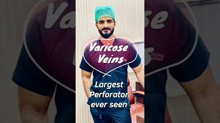 Varicose Veins | Largest Perforator | Clinical Examination @Tayyabriazch