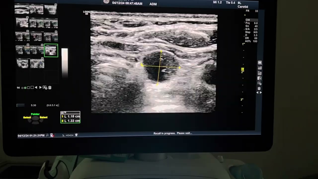 Kinh nghiệm chẩn đoán nhân giáp.