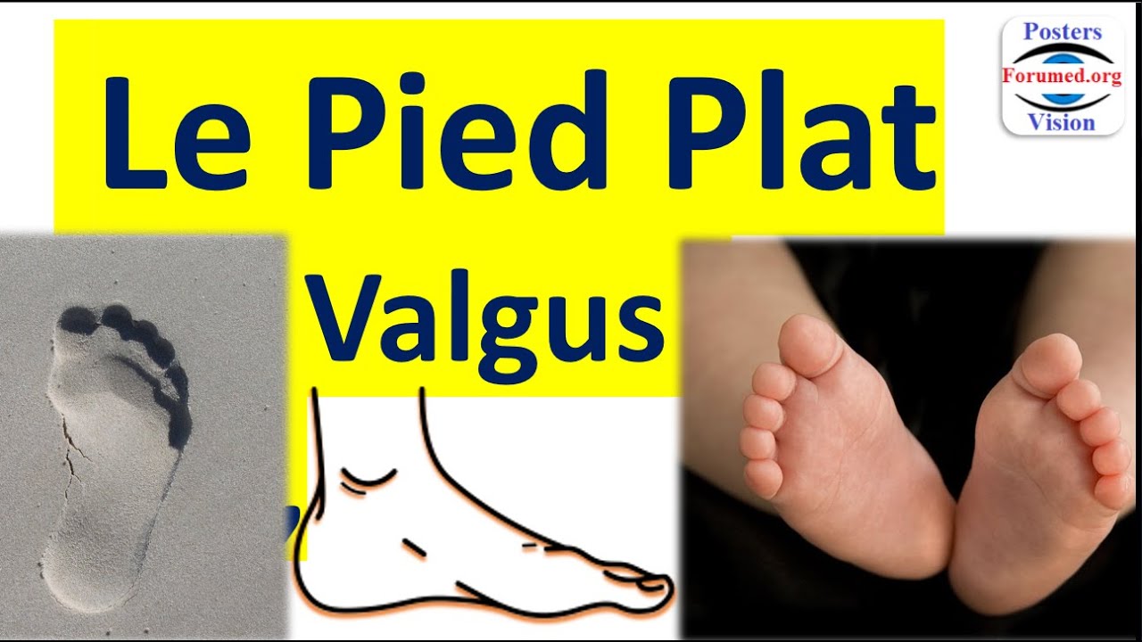 Le pied plat -  %