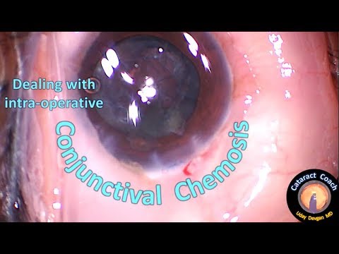 Dealing with Conjunctival Chemosis during Cataract Surgery