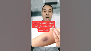 خطورة ظهور لون ازرق زي الكدمات علي الجلد بدون سبب 