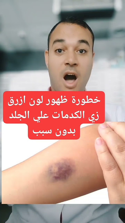 خطورة ظهور لون ازرق زي الكدمات علي الجلد بدون سبب