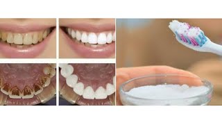how I whiten My Teeth At Home in 3 Days and remove Dental plaque Without Going to The Dentist ?