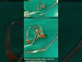 pulpectomy live patient demonstration || video 3 #atozkidsdental #toothisland #pulpectomy