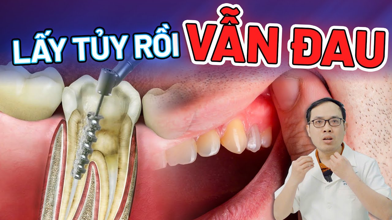 Outline Video Răng Lấy Tủy Rồi Vẫn Đau: 3 Sự Thật Giật Mình, Có Đến 90% Người Gặp Phải
