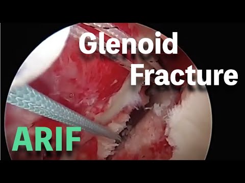 関節窩骨折に対する鏡視下手術  Glenoid Fracture: Arthroscopic Reduction and Internal Fixation Using Suture Anchor