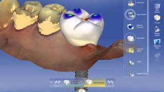 CEREC TiBase - Design #14