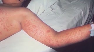 'DO NOT WAIT': JoCo says providers should report probable measles cases