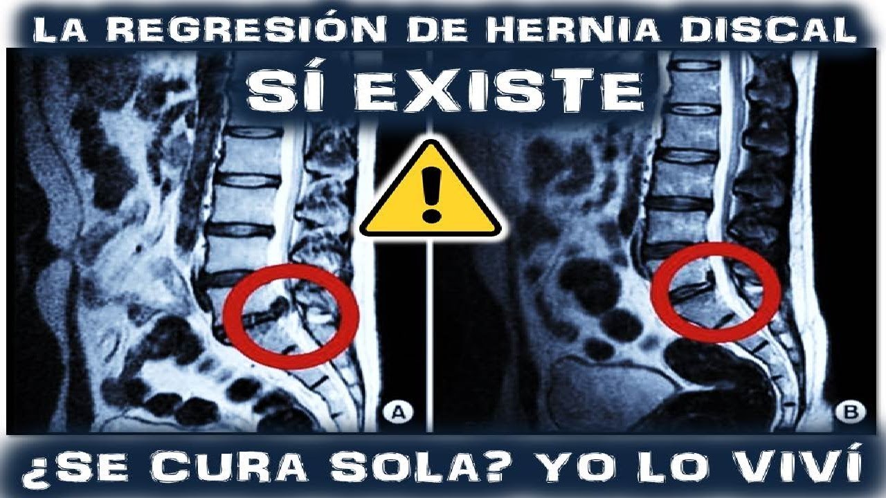 ejercicios ciatica pierna derecha HERNIA DISCAL LUMBAR TRATAMIENTO SIN CIRUGÍA POR REGRESIÓN DISCAL! SI EXISTE!