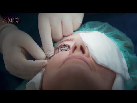 Wideo: Obrzęk Rogówki: Leczenie, Operacja I Czas Gojenia