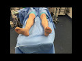 Fasciotomy for Chronic Exertional Compartment Syndrome of the Leg