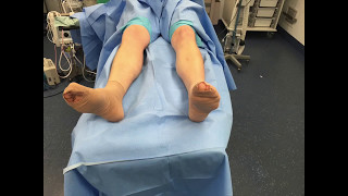 Fasciotomy For Chronic Exertional Compartment Syndrome Of The Leg