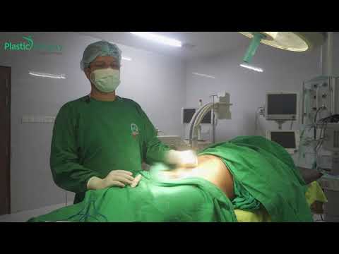 Penis Enlargement Surgery | লিঙ্গ বড় করার সার্জারি | penile lengthening surgery