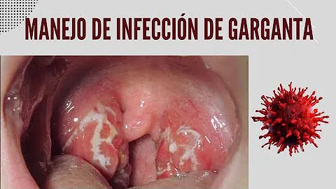 ¿La infección de garganta desaparece sin antibióticos?