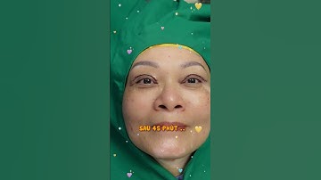 Khắc phục sụp mí cho cô Khách Hàng 65T | Dr Hùng Thanh