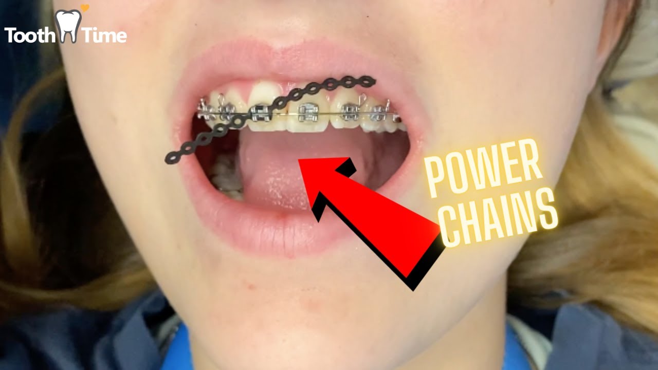 Braces and Power Chains