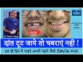 Broken Tooth Repaired in just 1 Day I YouDent India Hospitals Jaipur