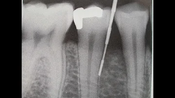 ¿Se ve un absceso dental en una radiografía?