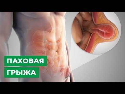 Паховая грыжа