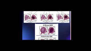 Mastering Bicuspid Aortic Valve Classification: Siever's vs International Consensus