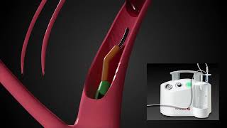 MedArt Example Video - Penumbra Indigo 3D Product Animation 2016