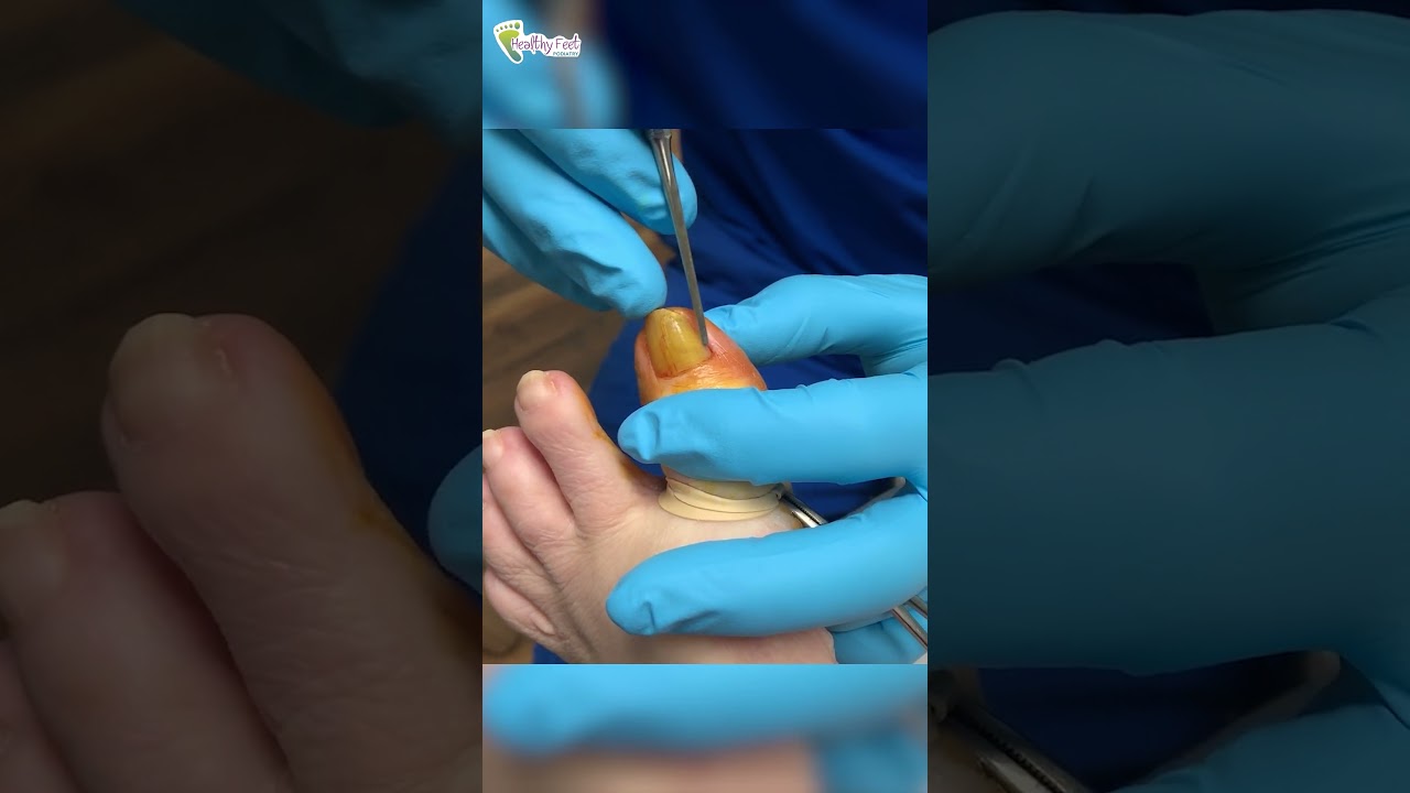 Painful ingrown toenail removal by Dr. Binh Nguyen #toenails #podiatry #healthyfeet #toefl