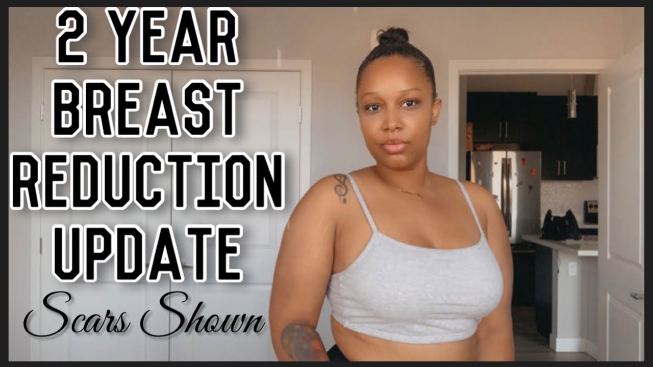 2 Year Breast Reduction Update!
