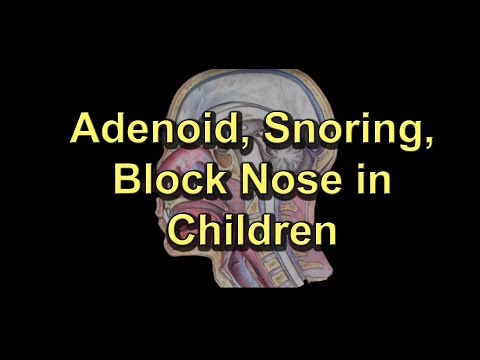 Video: Adenoid Di Hidung Pada Anak-anak: Gejala Dan Pengobatan, Foto, Tampilannya