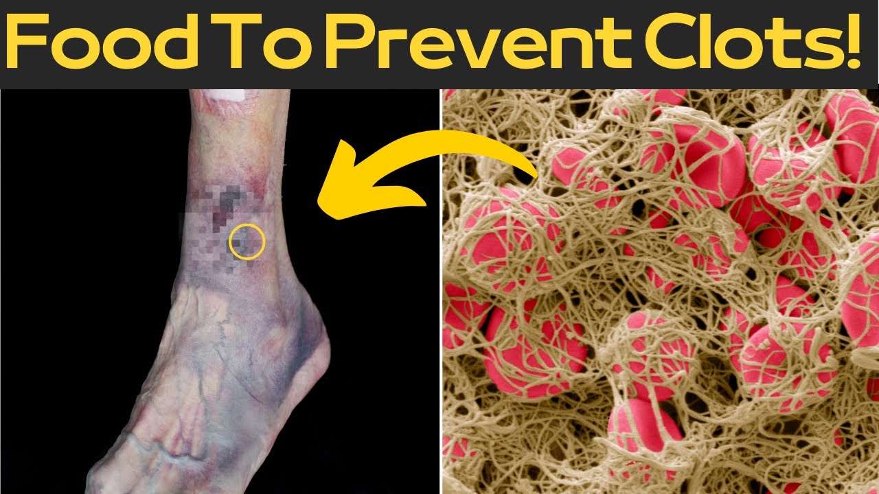 NEVER Worry About Clots Again! 8 Secret Foods REVEALED! YouTube