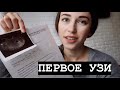 ПЕРВОЕ УЗИ🙌🏻ОТСЛОЙКА / ТОКСИКОЗ /
5- 7 НЕДЕЛЬ БЕРЕМЕННОСТИ🤍