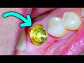 Dental implant procedure to replace a single missing tooth on a back molar w placement  insertion