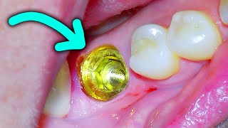 Dental Implant Procedure To Replace A Single Missing Tooth on a Back Molar! w/ Placement & Insertion