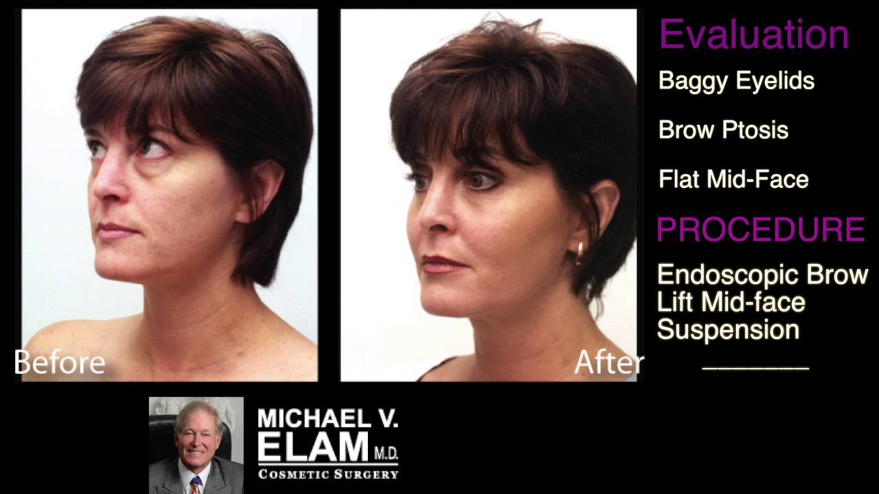 Fixing a Tired Looking Face - Dr. Elam's Evaluation - 