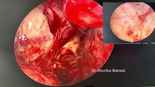 Functional Endoscopic Sinus Surgery(FESS)#nasalpolyps #ent #fess 