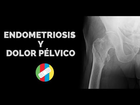 Vídeo: Dolor En La Pierna Con Endometriosis: Identificación, Tratamiento Y Más