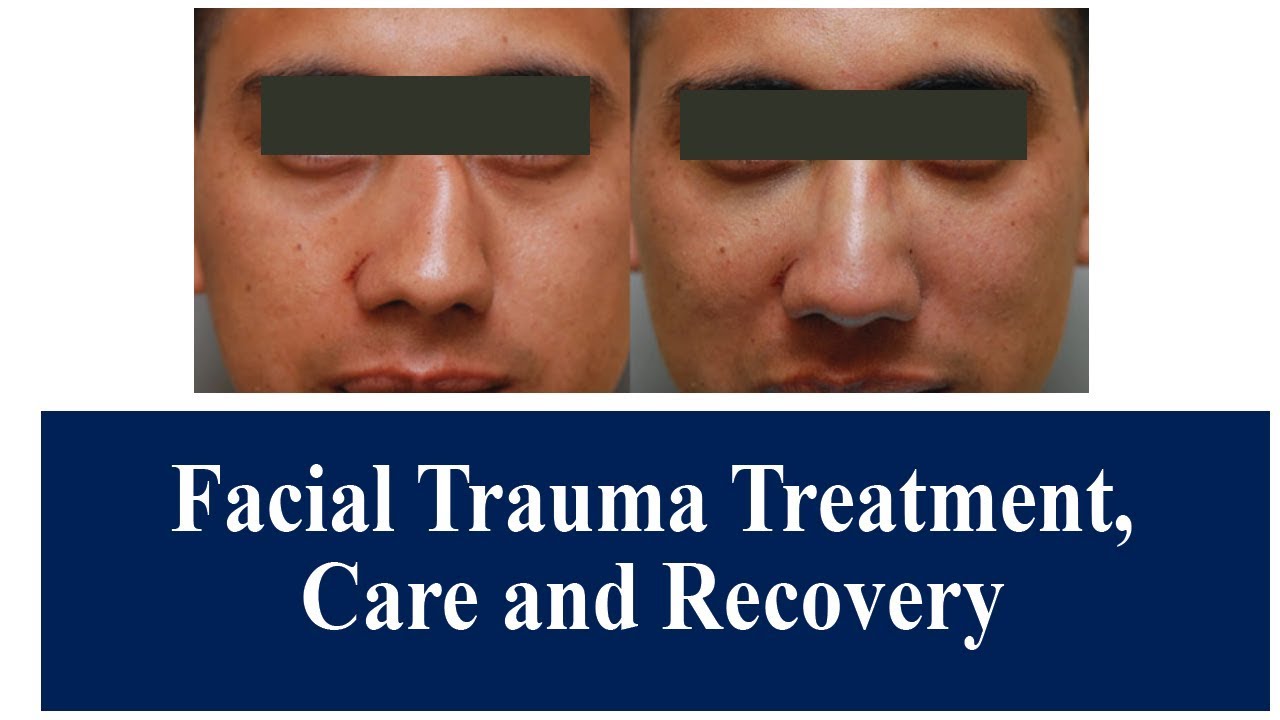 Facial Trauma & Fractures Repair | The Esthetic Clinics, India