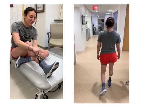 Osseointegration for Trans-tibial Amputation - Osseointegration for Trans-tibial Amputation