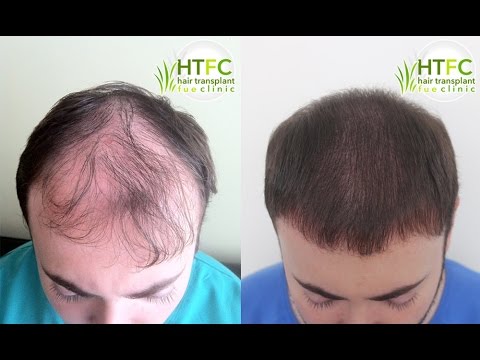 Fue Hair Transplant Turkey Haartransplantation Turkei 4500 Grafts Ankara Istanbul Youtube