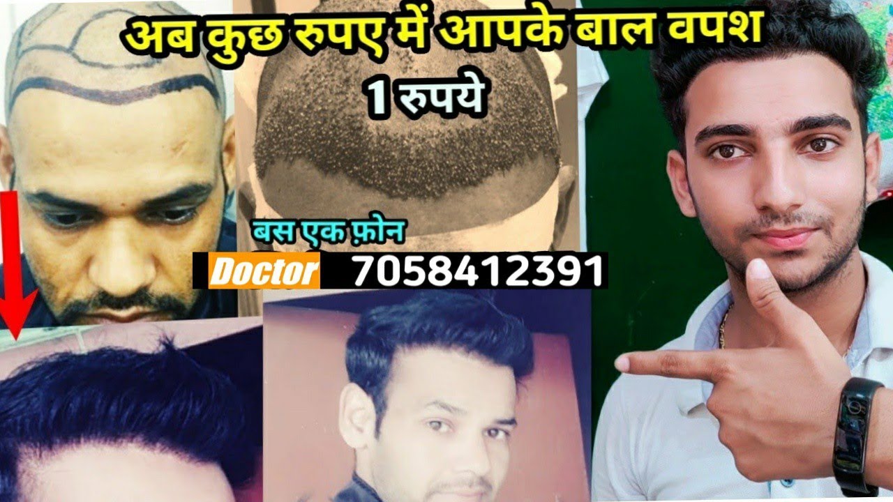 Hair Transplant in 100 Result India and Successful Result before and after Hair Transplant
