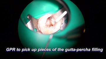 17878 broken file removal with ultrasonics from the start to end real time