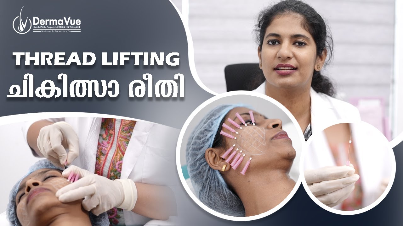 Threadlifting 🌟