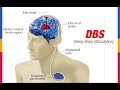 DBS (Deep Brain Stimulation)
